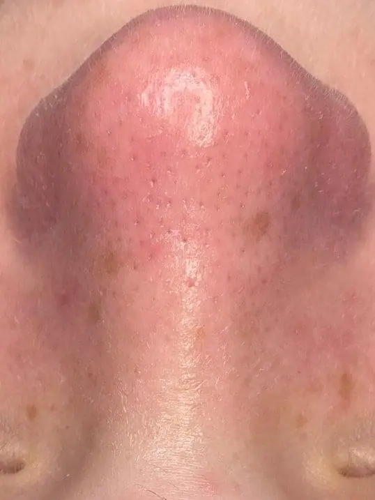 HydraFacial® with Extended Extractions after