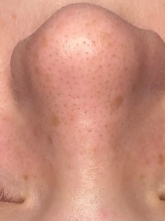 HydraFacial® with Extended Extractions before