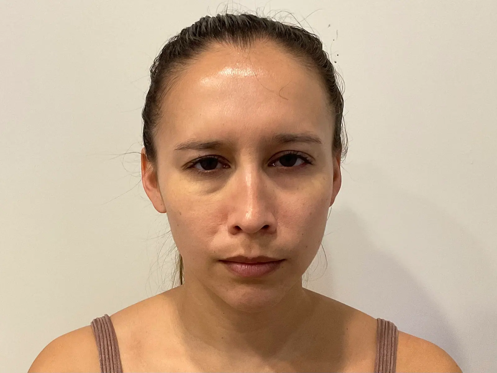 Upper-Face BOTOX® by Mini after treatment at ZO Skin Centre Houston