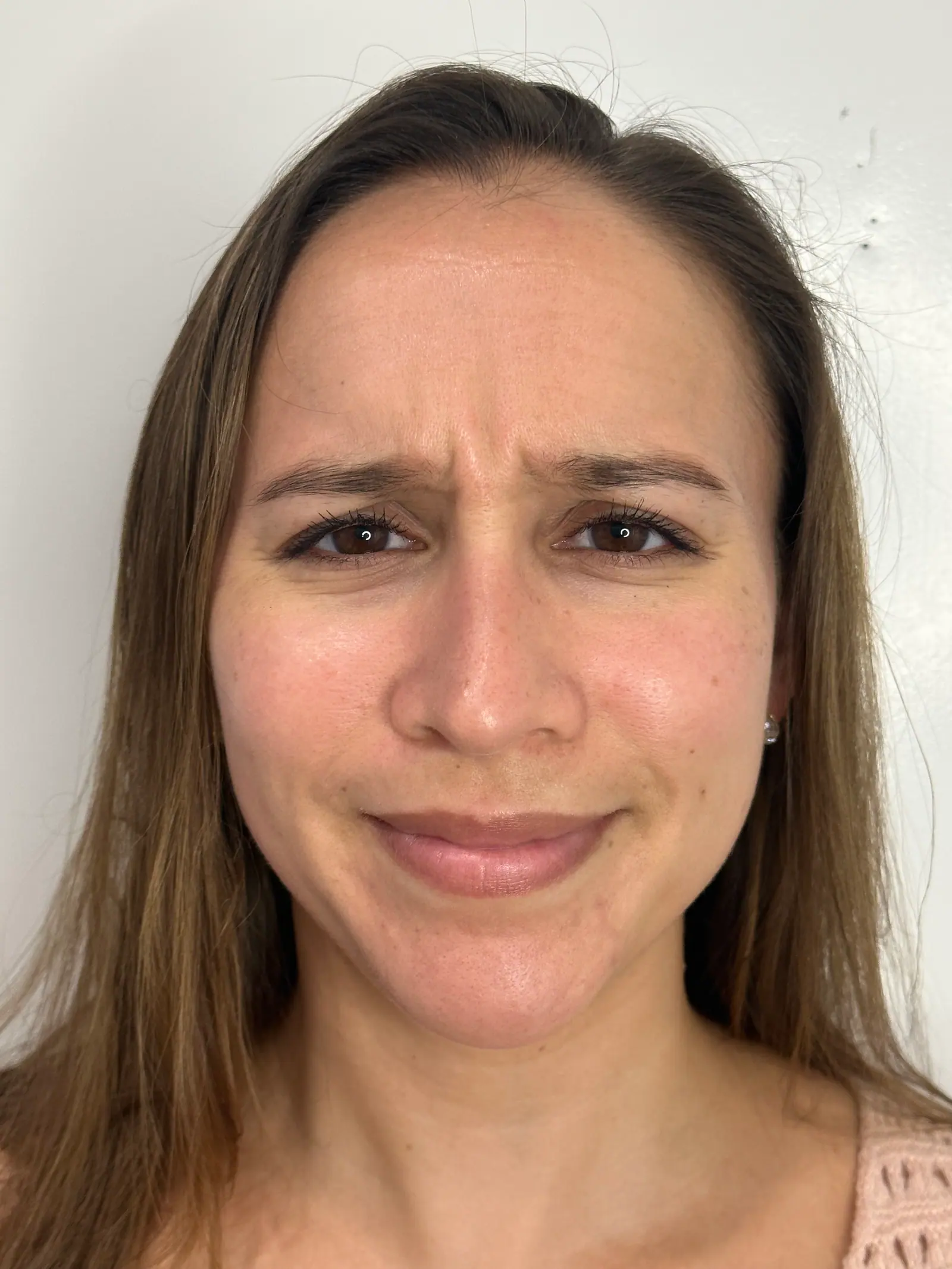 Upper-Face BOTOX® by Mini before treatment at ZO Skin Centre Houston