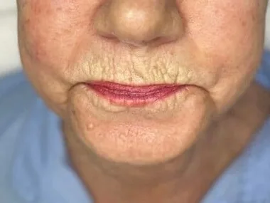 Crepey lines around the mouth of a clinic patient. The photo shows the concern. It is not a treatment result.