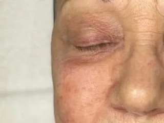 Uneven, sun-flushed color on the cheek of a clinic patient. The photo shows the concern. It is not a treatment result.