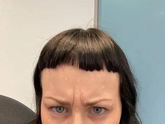 Dysport® For Glabellar Lines before treatment at ZO Skin Centre Dallas