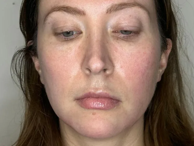 Front view of a clinic patient, with flat cheeks and a hollow under the eyes. The photo shows the concern. It is not a treatment result.