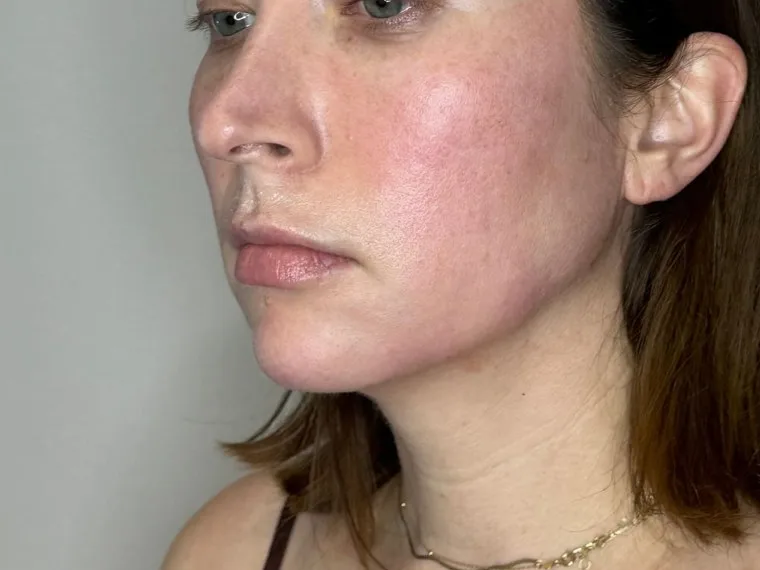 Side view of a clinic patient, with the chin sitting slightly behind the lips. The photo shows the concern. It is not a treatment result.