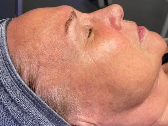 ZO HydraFacial® after treatment at ZO Skin Centre Dallas