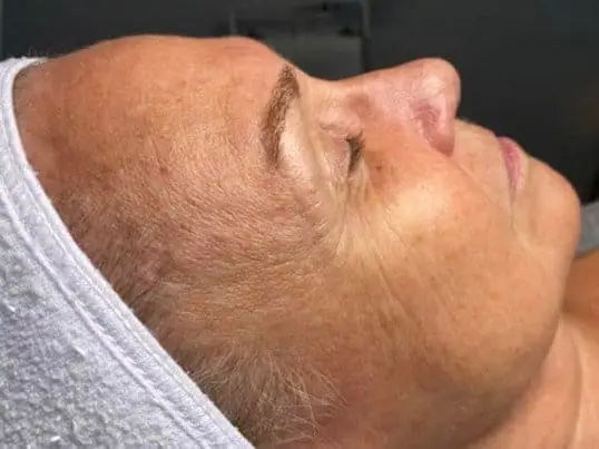 ZO HydraFacial® before treatment at ZO Skin Centre Dallas