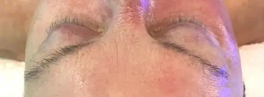 HydraFacial® after treatment at ZO Skin Centre Dallas
