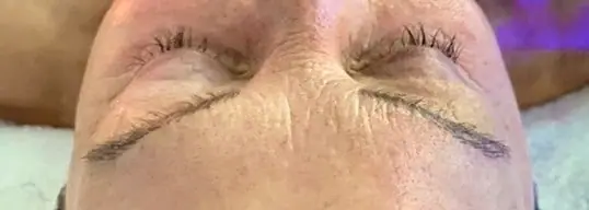 HydraFacial® before treatment at ZO Skin Centre Dallas