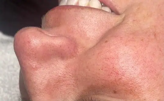 HydraFacial® Treatment Result after