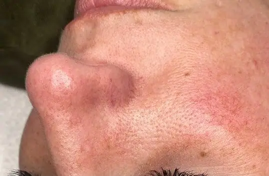HydraFacial® Treatment Result before