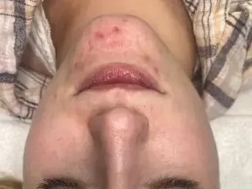 Small blemishes on the chin of a clinic patient. The photo shows the concern. It is not a treatment result.