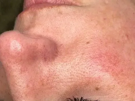 A flushed cheek on a clinic patient. The photo shows the concern. It is not a treatment result.