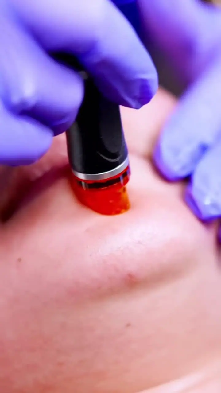HydraFacial® treatment detail