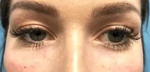Juvederm after treatment at ZO Skin Centre
