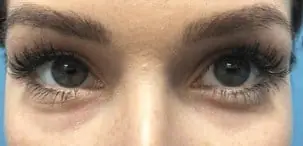 Juvederm before treatment at ZO Skin Centre