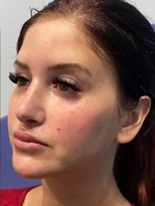 Beautiful Restylane Contour in Mid Face after