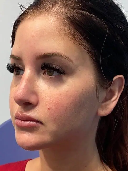Beautiful Restylane Contour in Mid Face before