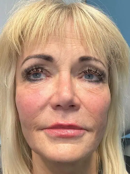 Restylane Lip & Chin Filler after treatment at ZO Skin Centre Dallas