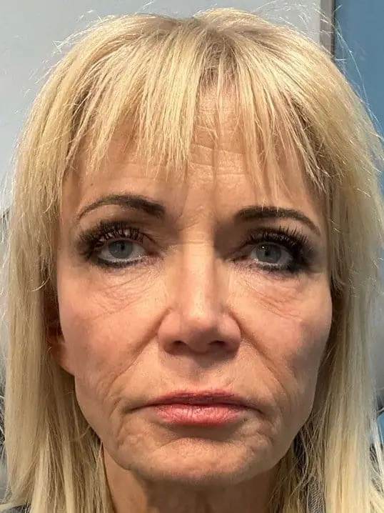 Restylane Lip & Chin Filler before treatment at ZO Skin Centre Dallas