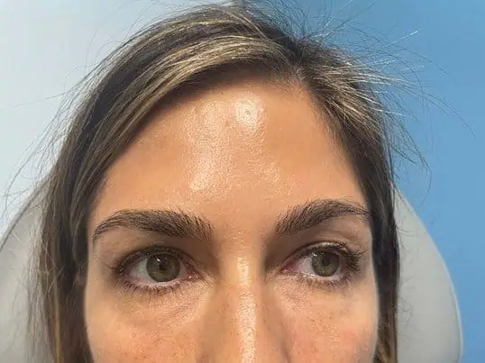 Restylane® after treatment at ZO Skin Centre Dallas