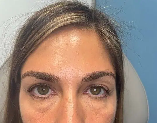 Restylane® before treatment at ZO Skin Centre Dallas
