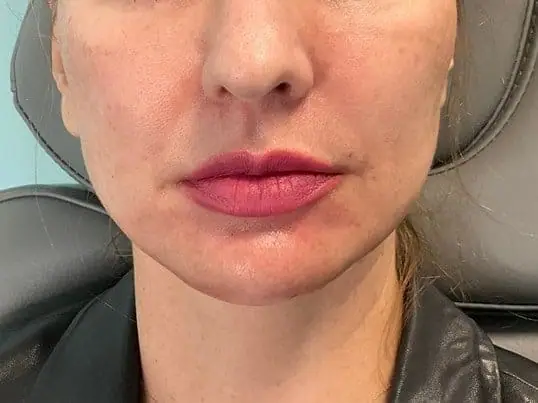 AMAZING Chin Filler Treatment after