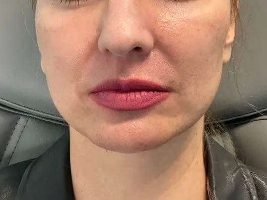 AMAZING Chin Filler Treatment before