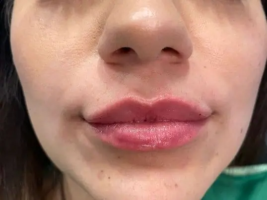 Restylane Refyne Dermal Filler after treatment at ZO Skin Centre Dallas