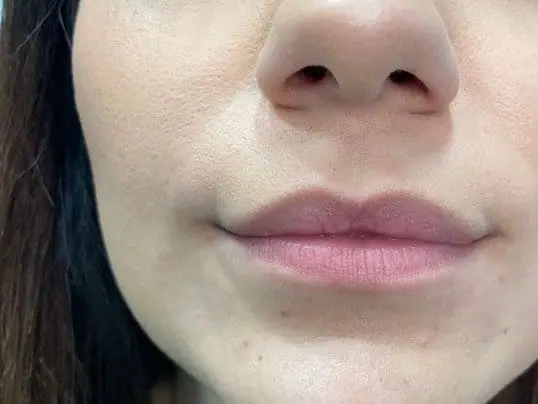 Restylane Refyne Dermal Filler before treatment at ZO Skin Centre Dallas
