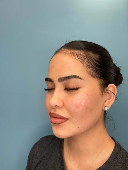 RHA Fillers May Be the Best Anti-Aging Injectable Yet! after treatment at ZO Skin Centre Dallas