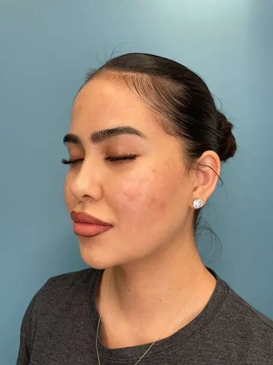 RHA Fillers May Be the Best Anti-Aging Injectable Yet! before treatment at ZO Skin Centre Dallas