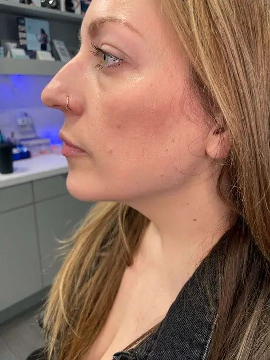 Jawline Contouring with Radiesse after