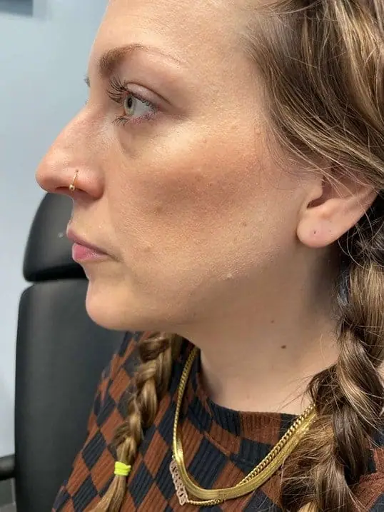 Jawline Contouring with Radiesse before