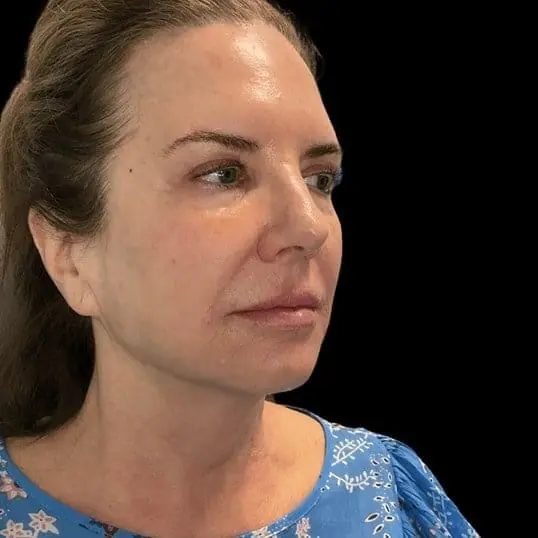 The Fountain of Youth after treatment at ZO Skin Centre Dallas