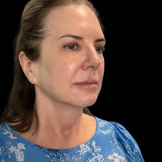 The Fountain of Youth before treatment at ZO Skin Centre Dallas