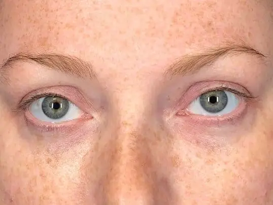 Under Eye Magic Using Restylane-L after treatment at ZO Skin Centre Dallas