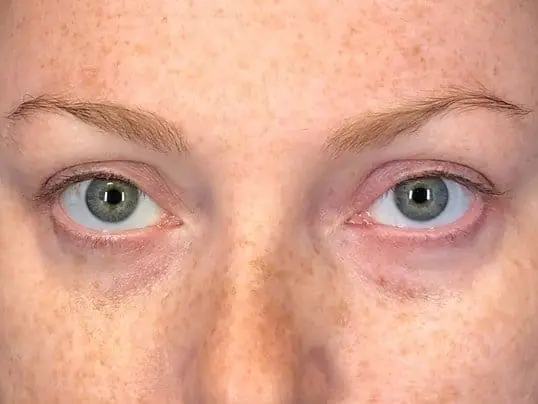 Under Eye Magic Using Restylane-L before treatment at ZO Skin Centre Dallas