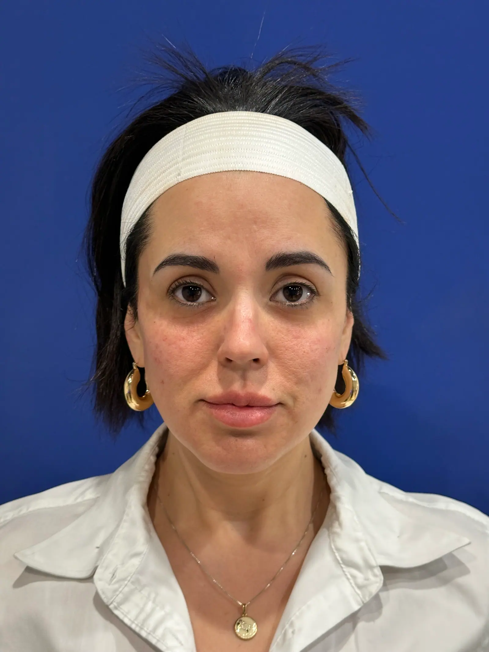 Under-Eye + Mid-Cheek Filler by Mini after treatment at ZO Skin Centre Houston