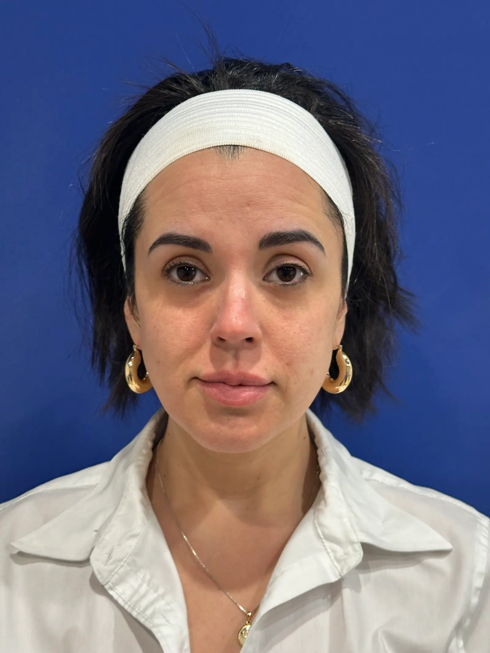Under-Eye + Mid-Cheek Filler by Mini before treatment at ZO Skin Centre Houston