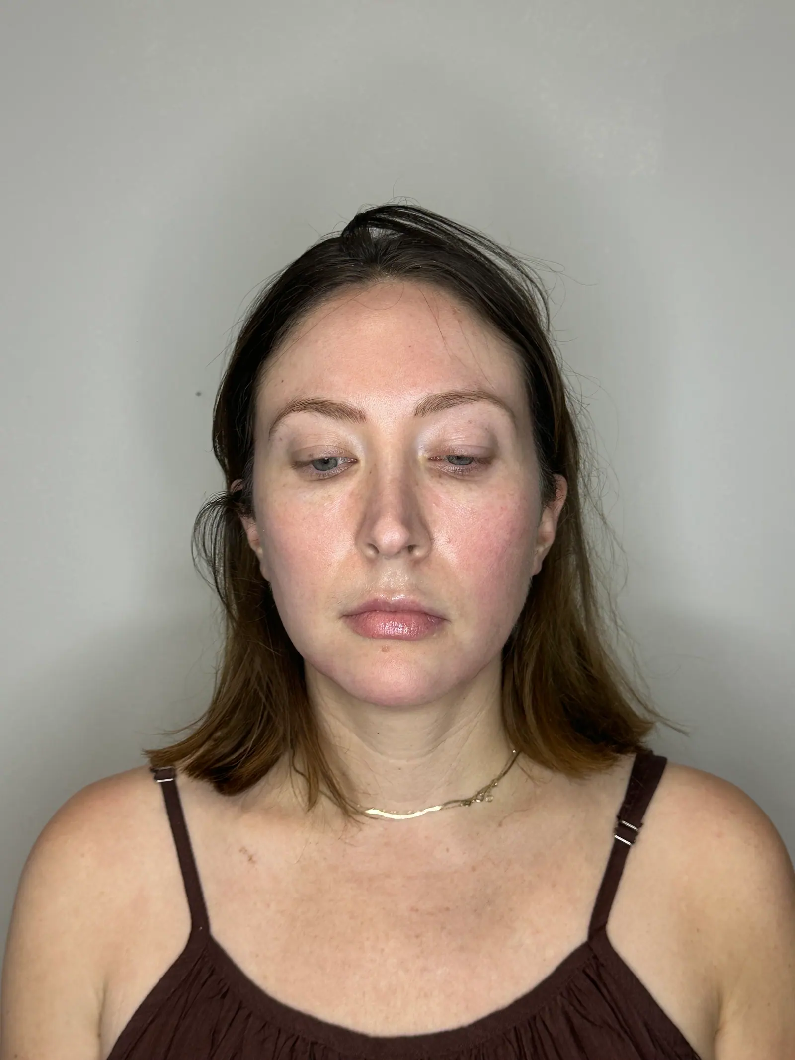 Facial Balancing by Mini before treatment at ZO Skin Centre Houston