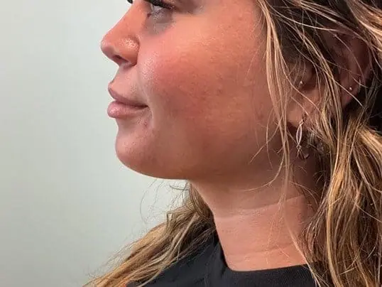 Patient Receives Kybella®, Transforming Their Appearance after treatment at ZO Skin Centre Dallas