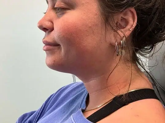 Patient Receives Kybella®, Transforming Their Appearance before treatment at ZO Skin Centre Dallas