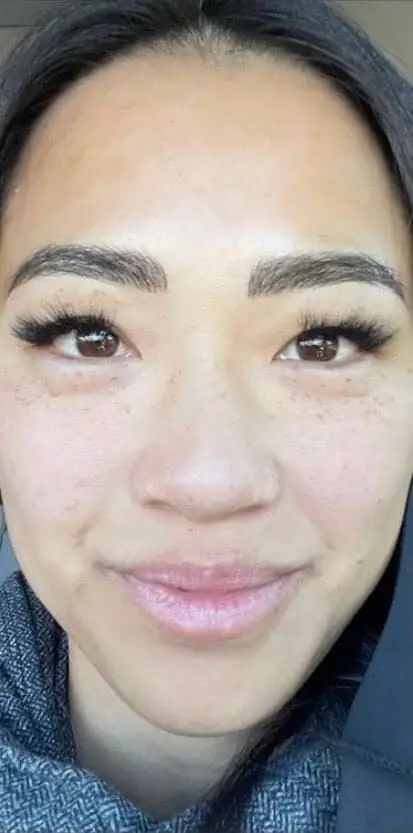 IPL after treatment at ZO Skin Centre Dallas