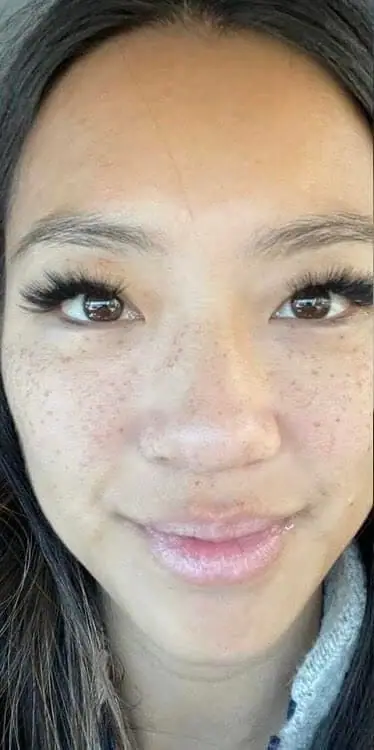 IPL before treatment at ZO Skin Centre Dallas
