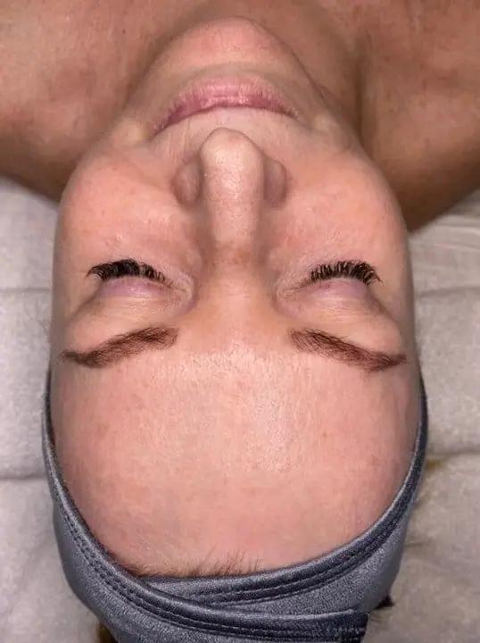 IPL/Photofacial after treatment at ZO Skin Centre Dallas