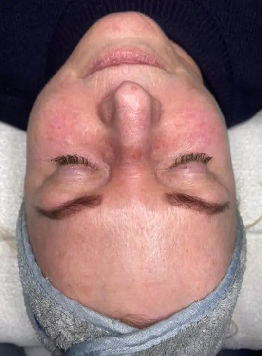 IPL/Photofacial before treatment at ZO Skin Centre Dallas