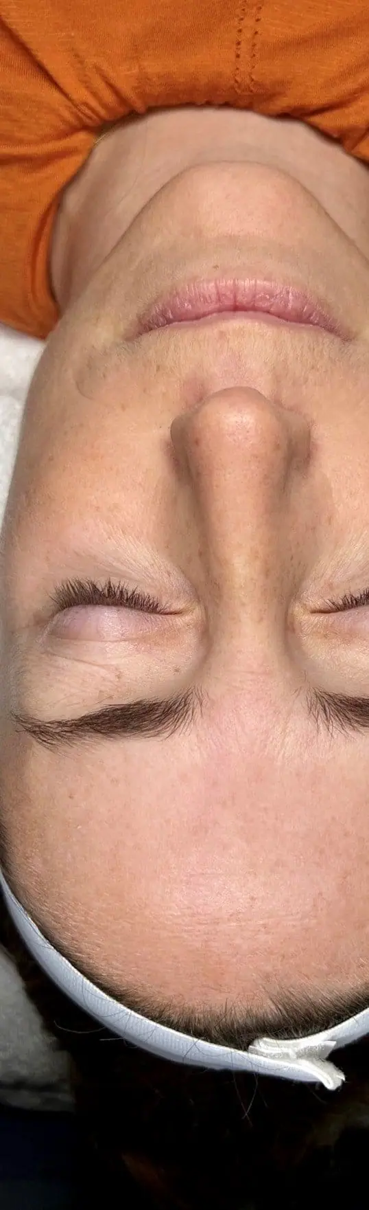 Patient Receives IPL and ZO Skin Health Protocol after treatment at ZO Skin Centre Dallas