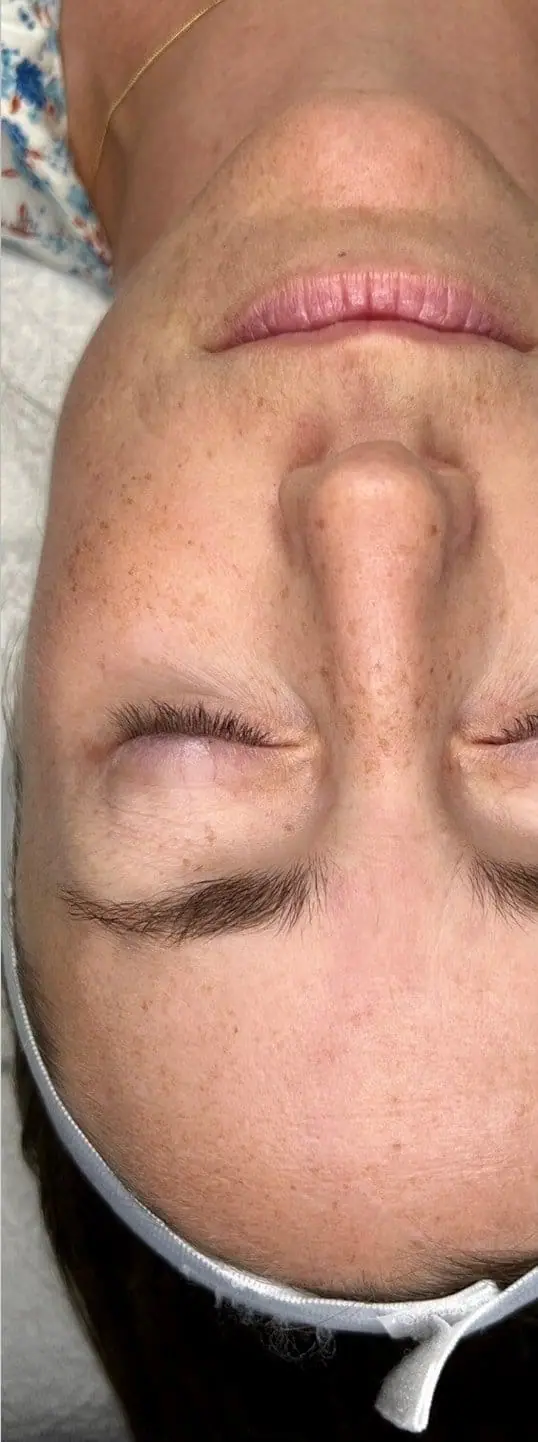 Patient Receives IPL and ZO Skin Health Protocol before treatment at ZO Skin Centre Dallas