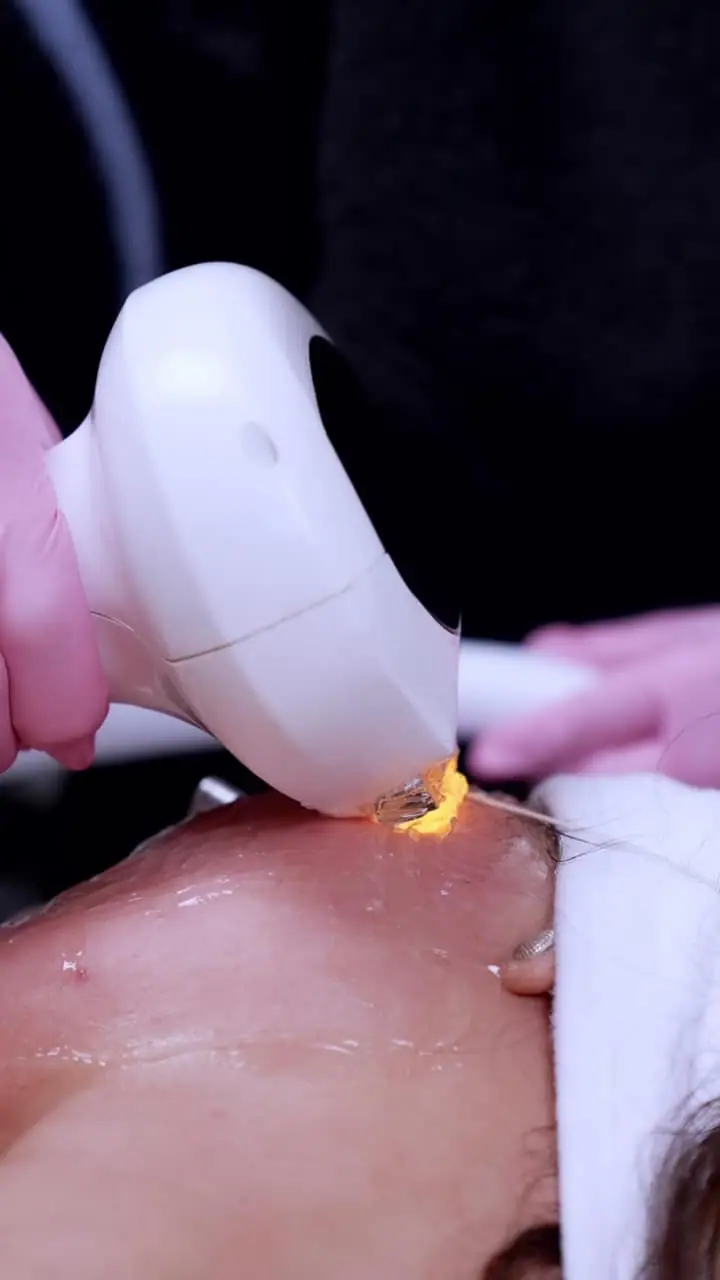 Lasers treatment detail